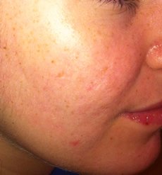 Behandlung von Akne - Ordination Haut im Zentrum - Eisenstadt