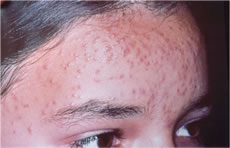 Behandlung von Akne - Ordination Haut im Zentrum - Eisenstadt